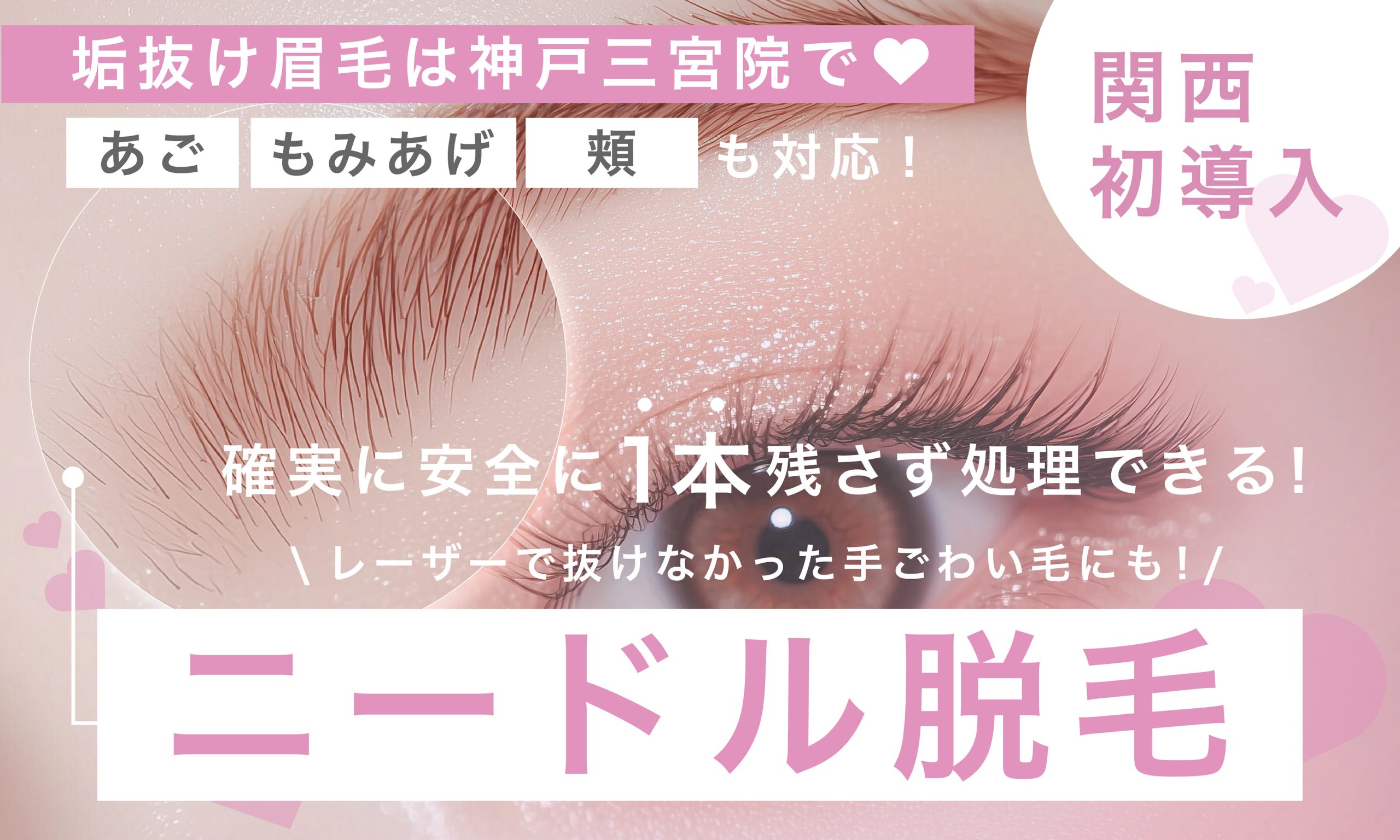 関西初導入♡ボディも可能なニードル脱毛